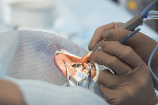 Cirugia de retina