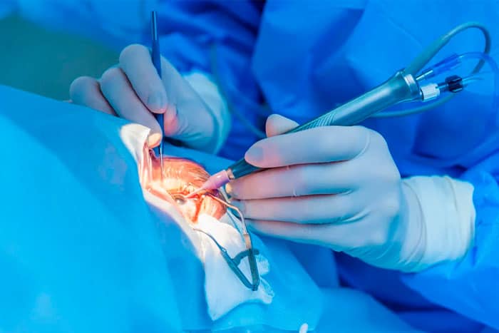 tratamiento-quirúrgico-de-carnosidad-avanzada