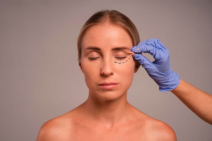 blefaroplastia-precio-Lima