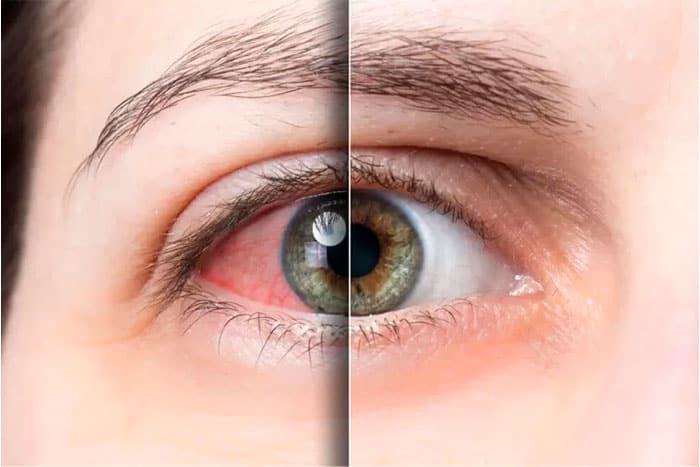 desprendimiento-de-retina-síntomas
