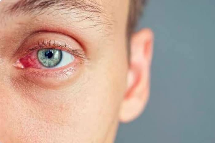 Úlcera corneal tratamiento lima