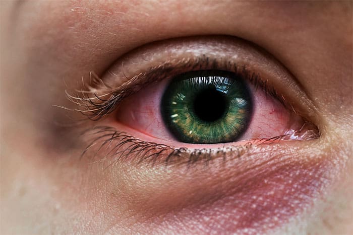 conjuntivitis-crónica-tratamiento