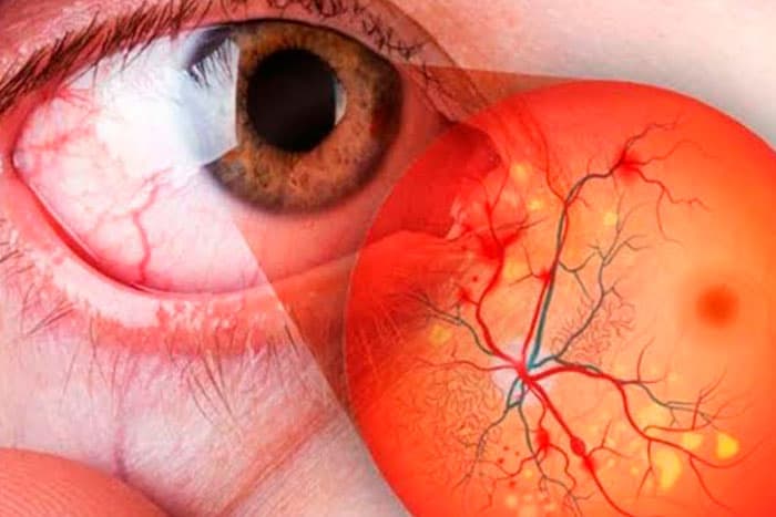 retinopatía-diabética-tratamiento-Lima