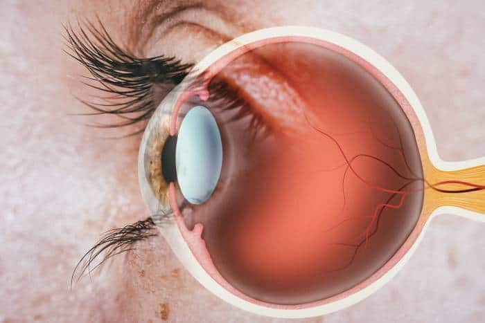 causas del desprendimiento de retina