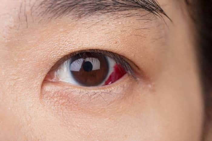desprendimiento de retina